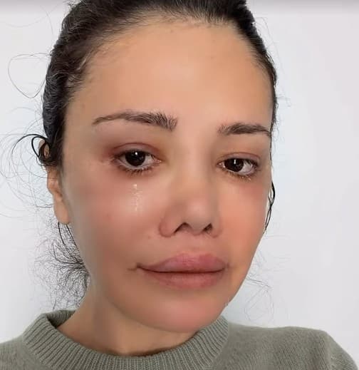 Didem Ceran ameliyat sonrası morluklu haliyle sosyal medya paylaşımında